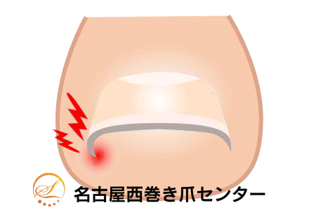 巻き爪矯正の図