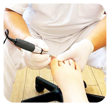 巻き爪の矯正風景